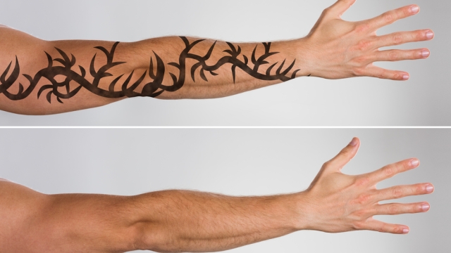 How Take Away Tattoos Yourself – Home Design Tattoo Removal