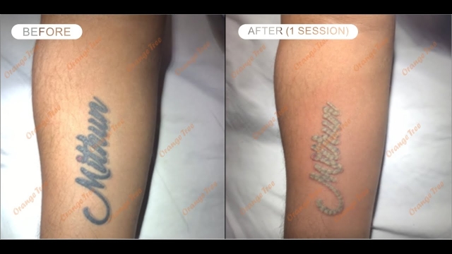 Tattoo Removal – The Truth Dissected