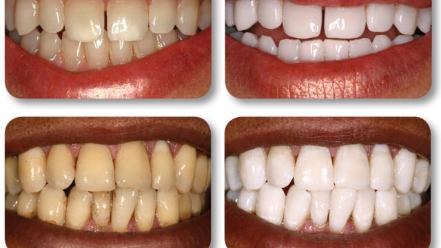 Brilliant Smiles: Discover the Secrets of Teeth Whitening